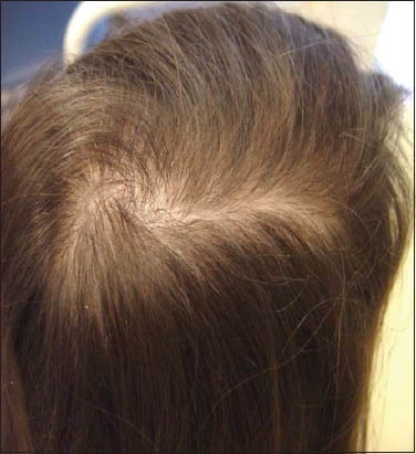 Signs of hair loss from steroids