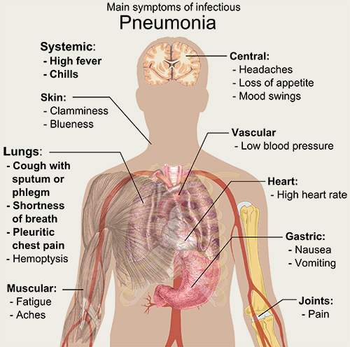 Main_symptoms_of_infectious_pneumonia